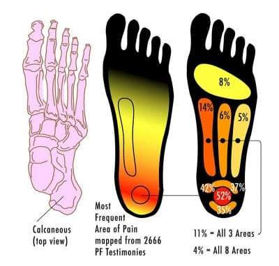 Pain Management for Plantar Fasciitis in Lakeland, Florida