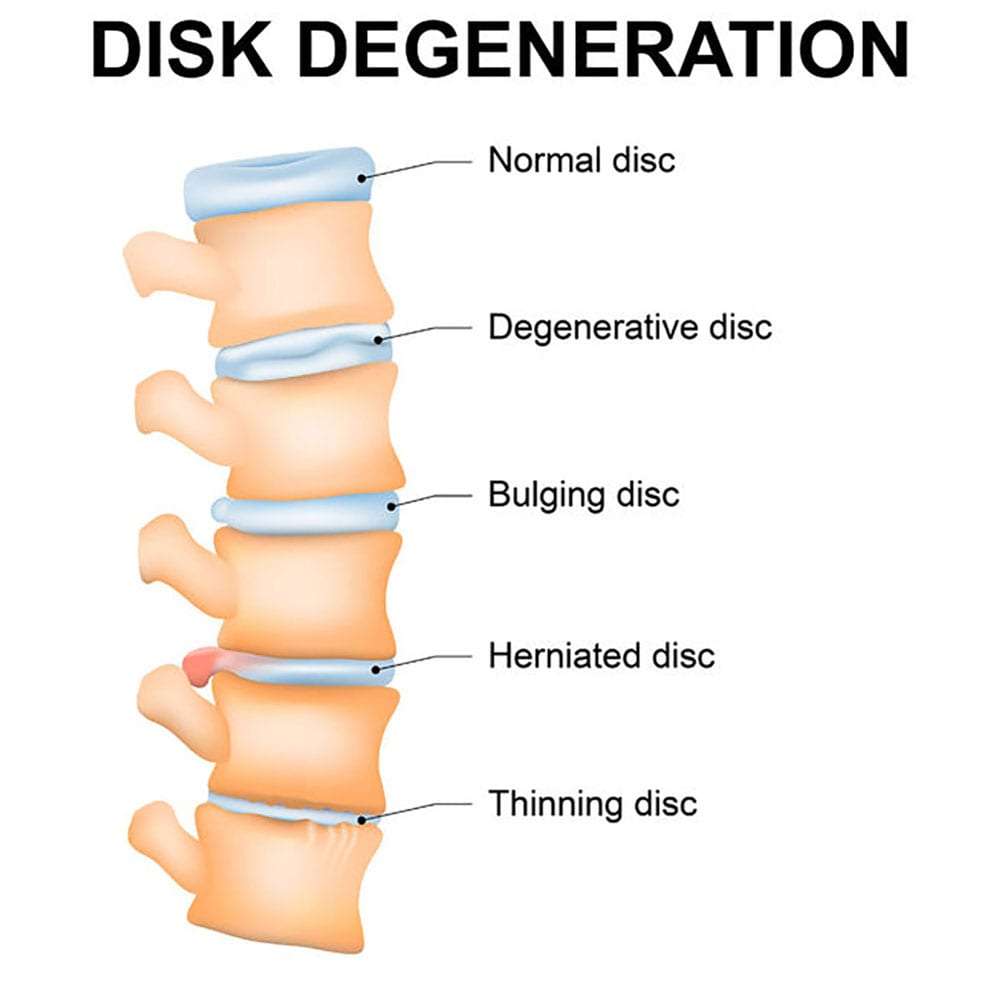 Pain Management for Degenerative Disc Disease in Lakeland, Florida