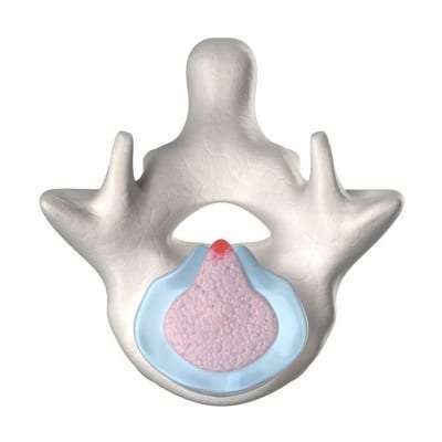 Pain Management for an extruded disc in Lakeland, Florida