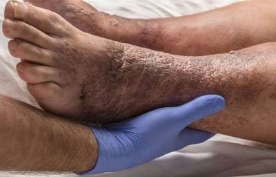 Pain Management of Stasis Dermatitis in Lakeland, Florida