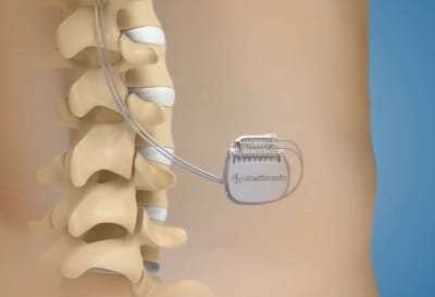 Non-drug pain management with Spinal Cord Stimulation in Lakeland, Florida