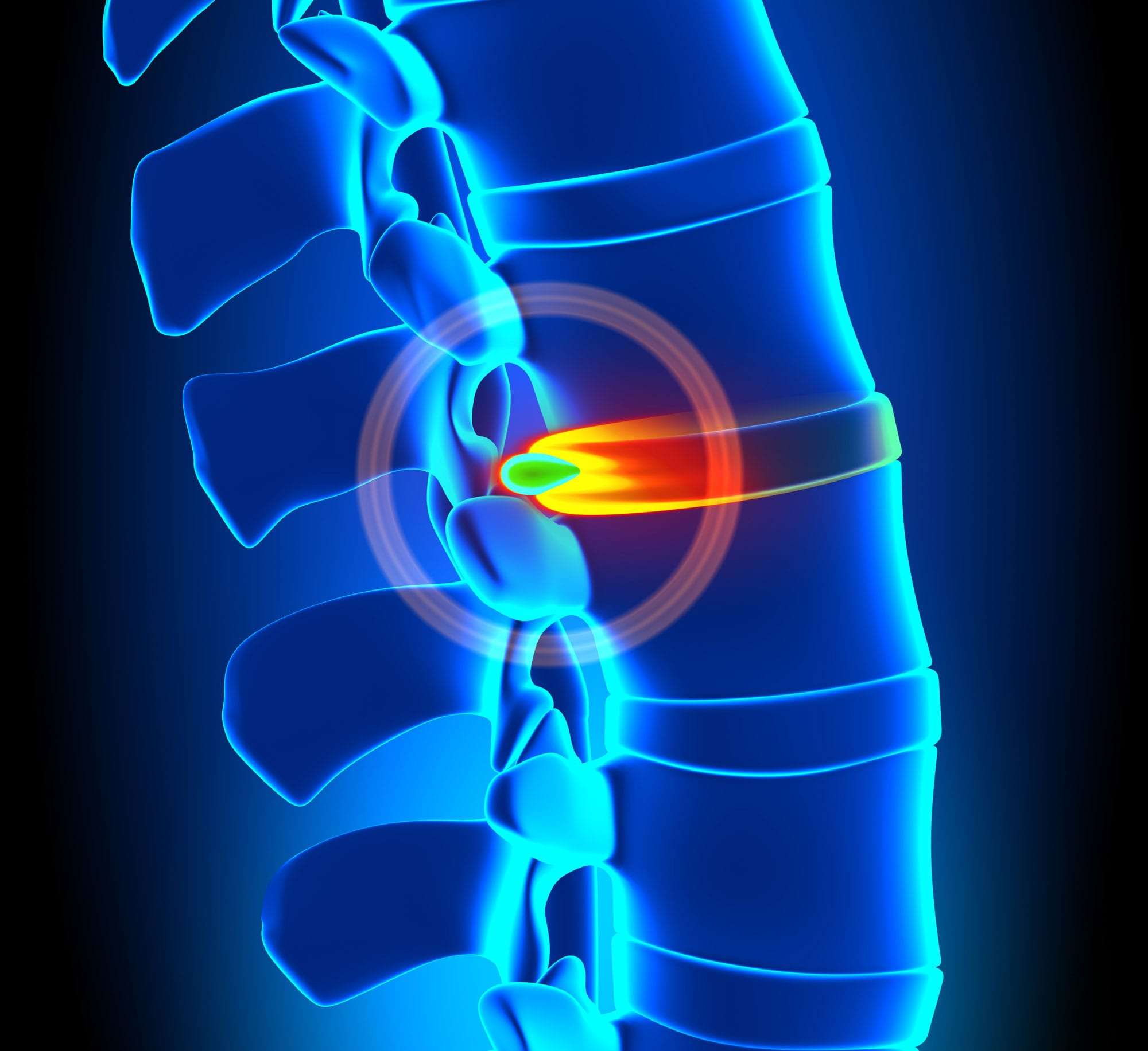 Herniated Disc Treatments | Novus Spine & Pain Center in Lakeland, FL