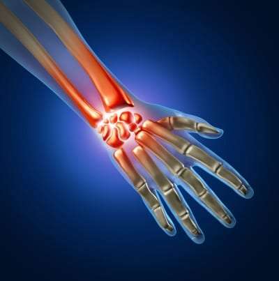 Pain Management Treatments for Carpal Tunnel Syndrome in Lakeland, Florida