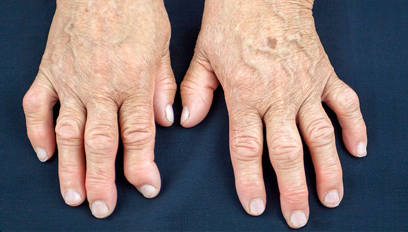 Treating Rheumatoid Arthritis in Lakeland, Florida