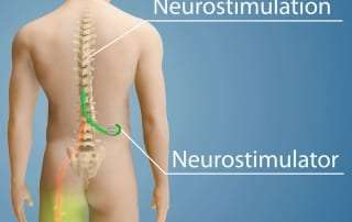 Pain management treatment with spinal cord stimulation for chronic pain in Lakeland, Florida