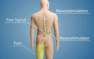 Spinal Cord Stimulator Implant Treatment in Lakeland, Florida