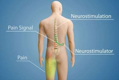 Spinal Cord Stimulator Implant Treatment in Lakeland, Florida