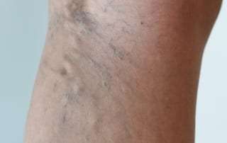 Treating Varicose Veins with Sclerotherapy in Lakeland, Florida
