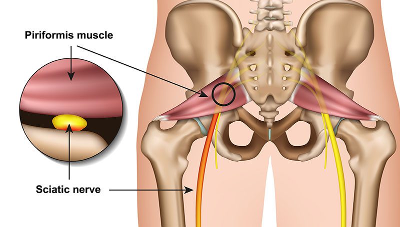 Treating Piriformis Syndrome in Lakeland, Florida