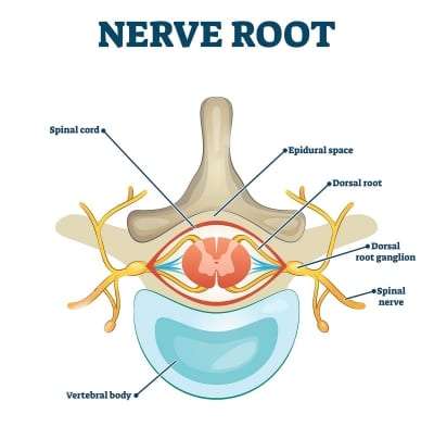 Dorsal root ganglion (DRG) stimulation in Lakeland, Florida