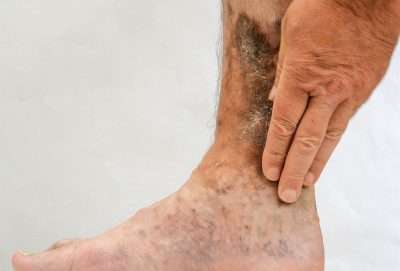 Venous Ulcer on leg Pain Treatment for Venous Ulcers in Lakeland, Florida