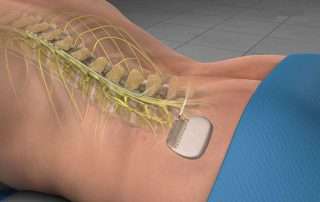 Spinal Cord Stimulator Implants can help relieve chronic back, arm, and leg pain