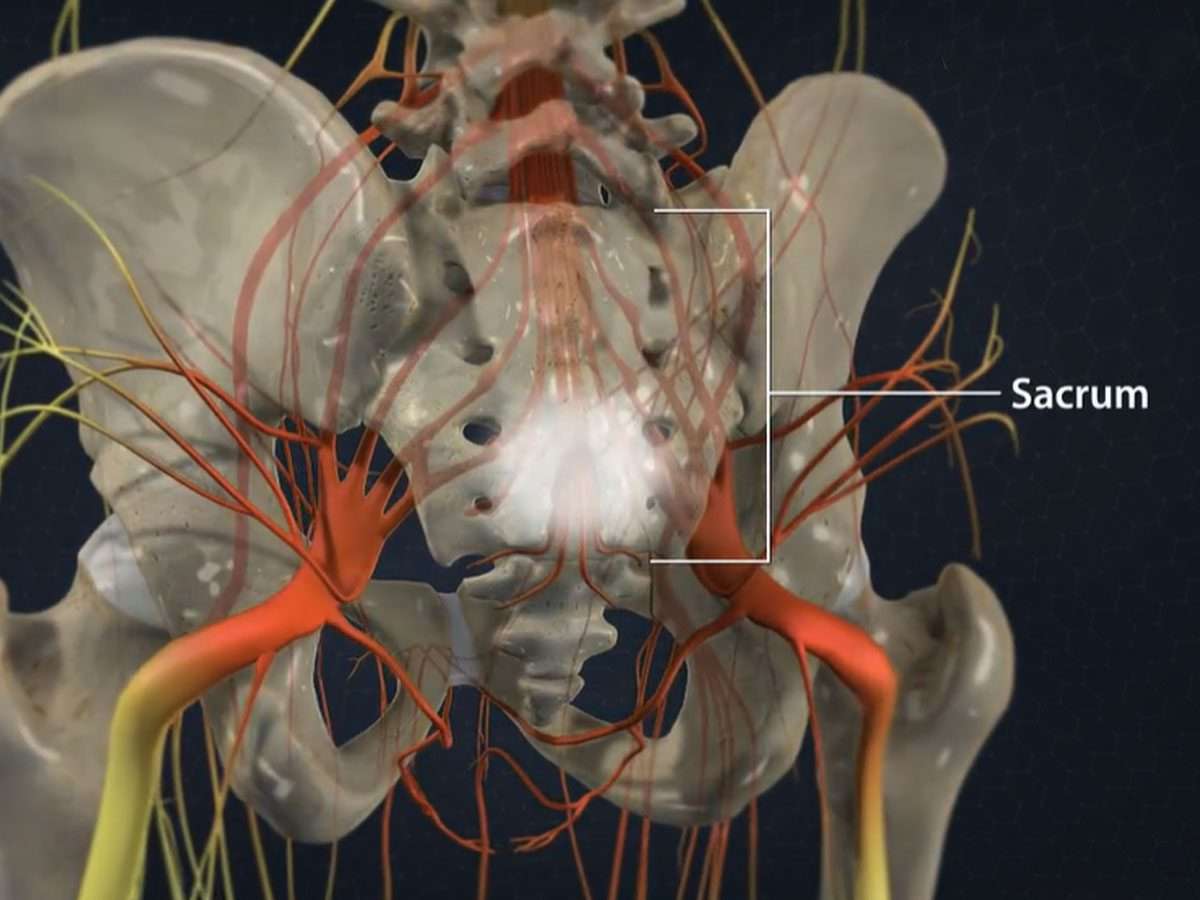 Caudal Steroid Injection