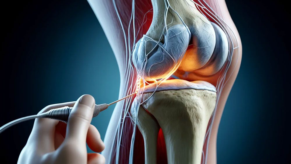 Genicular Nerve Radiofrequency Ablation A cutting-edge procedure to relieve chronic knee pain in Lakeland, Florida