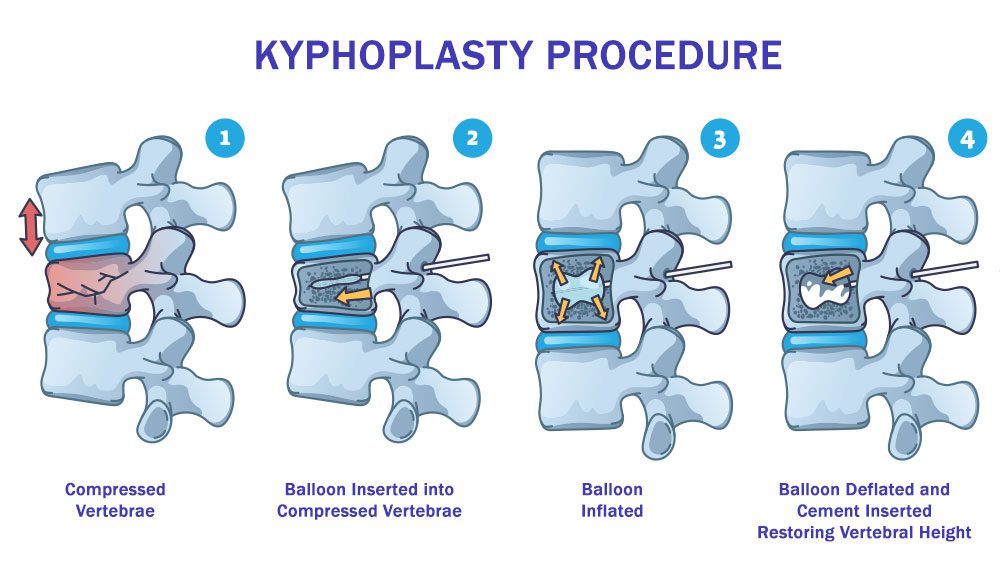 Detailed illustration of the kyphoplasty procedure
