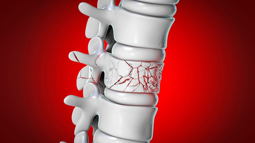 Compression fracture of the spine