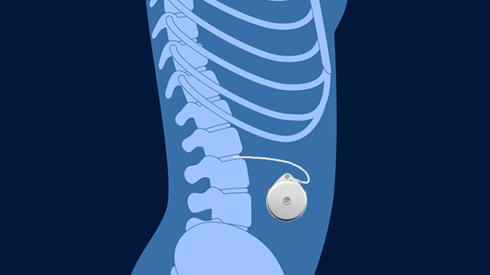 An implanted pain pump with a catheter delivering medication to a spinal disc