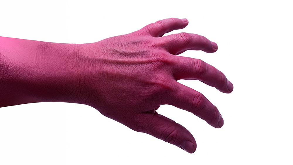 Hand of a man suffering from CRPS
